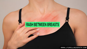 Rash Between Breasts